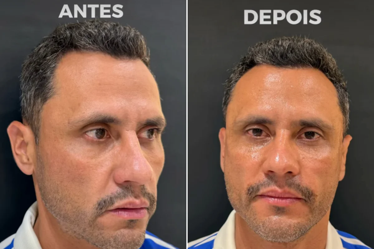 Eleito e harmonizado: Cleitinho faz procedimentos no rosto após campanha