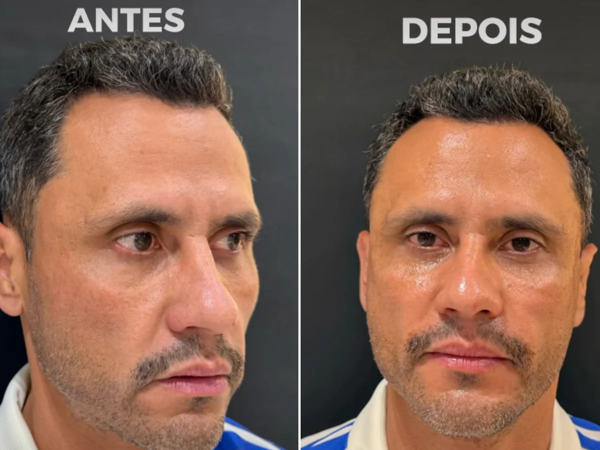 Eleito e harmonizado: Cleitinho faz procedimentos no rosto após campanha