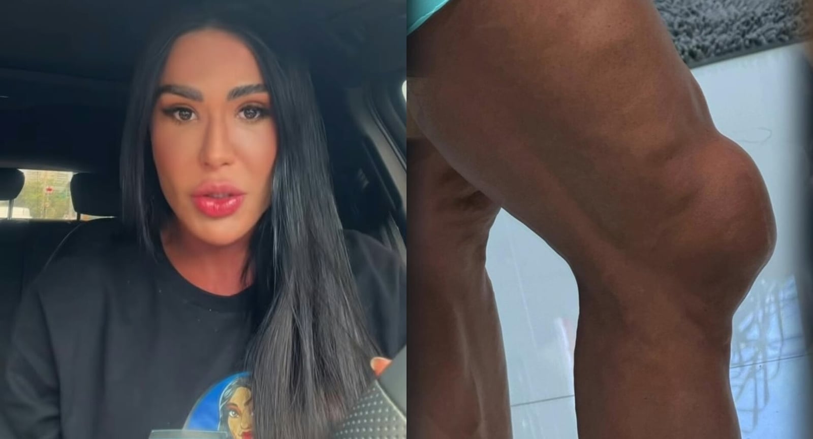 Gracyanne Barbosa e joelho (Foto: Instagram) Feed TV